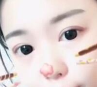 切開(kāi)雙眼皮+開(kāi)眼角手術(shù)前后對(duì)比圖恢復(fù)過(guò)程 昆山時(shí)光整形醫(yī)院