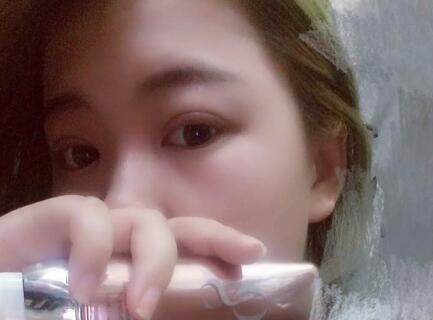 切開(kāi)雙眼皮+開(kāi)眼角手術(shù)前后對(duì)比圖恢復(fù)過(guò)程