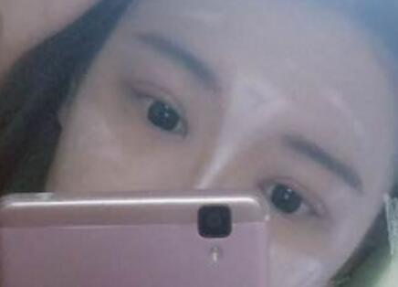 切開(kāi)雙眼皮+開(kāi)眼角手術(shù)前后對(duì)比圖恢復(fù)過(guò)程