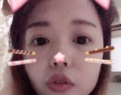 切開(kāi)雙眼皮+開(kāi)眼角手術(shù)前后對(duì)比圖恢復(fù)過(guò)程