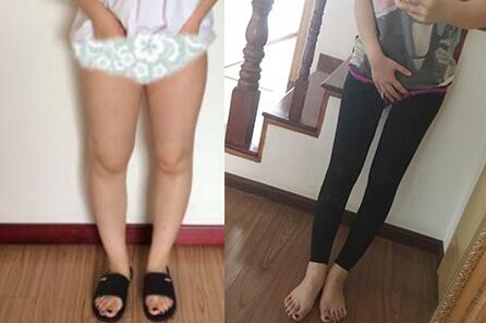 北京大腿吸脂減肥多少錢？哪家整形醫(yī)院好？正規(guī)醫(yī)院推薦