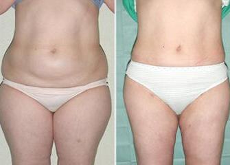 吸脂減肥前后對比