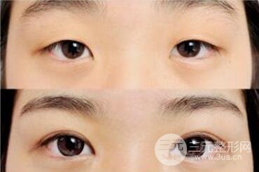 什么季節(jié)做雙眼皮好?割雙眼皮手術(shù)后隔多長時間才能拆線?