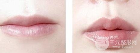 注射豐唇 讓你擁有性感可愛嘟嘟唇