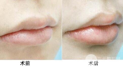 注射豐唇后有副作用嗎？