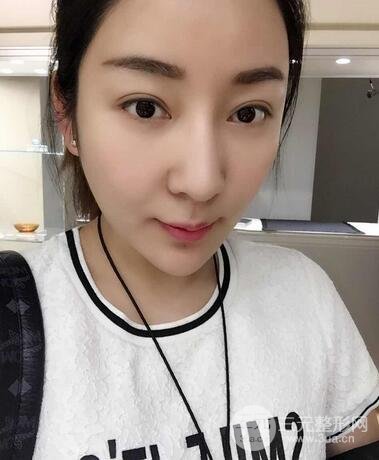 全臉線D圖片 線D恢復(fù)過程圖片