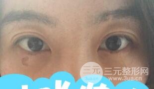 真人內(nèi)切去眼袋手術(shù)過程對(duì)比圖片和案例分享