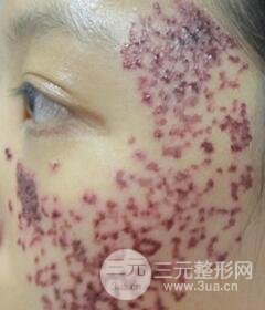 南寧緩解的太田痣真實案例,前后果對比圖