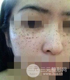 激光祛斑的恢復(fù)過程，逐步見證自己顏值的逐步提升。