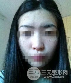 激光祛斑的恢復(fù)過程，逐步見證自己顏值的逐步提升。