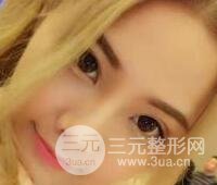 開內(nèi)眼角和三點(diǎn)定位雙眼皮恢復(fù)過程圖片真人案例分享