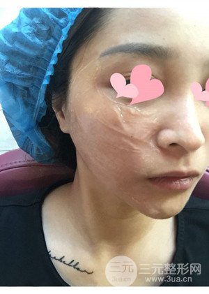 高強度聚焦超聲手術前后過程以及真實案例分享——廈門思明安黛美林韻醫(yī)生做的