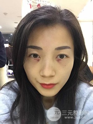 分享我的激光祛眼袋手術前后過程，廈門思明安黛美林韻醫(yī)生做的