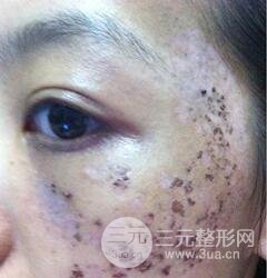 做了三次激光去太田痣，后來的果已經(jīng)是我較為滿意的了。