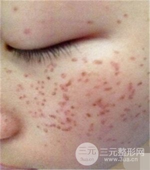 面部美白容整形激光祛斑手術(shù)恢復(fù)過程