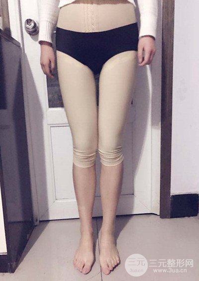大腿抽脂真實(shí)過(guò)程圖，輕松擁有細(xì)長(zhǎng)雙腿