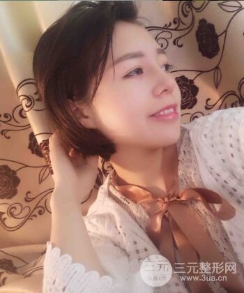 硅膠假體隆鼻+耳軟骨墊鼻尖四個(gè)月恢復(fù)果圖