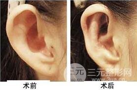招風(fēng)耳整形手術(shù)多少錢?矯正果圖