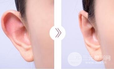招風(fēng)耳整形手術(shù)多少錢?矯正果圖