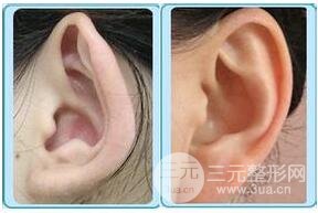 招風耳矯正好不好?會不會留疤?