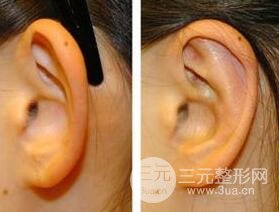 招風(fēng)耳矯正圖片，招風(fēng)耳矯正整形價格介紹
