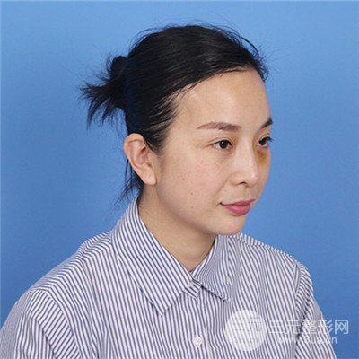 濟(jì)南曹博士美容醫(yī)院曹景敏埋埋蛋白線.提升真人案例分享