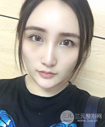 面部埋埋蛋白線.提升前后對比照片，皮膚緊致了不少