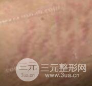 果酸換膚去妊娠紋真人案例和妊娠紋整形手術(shù)前后對(duì)比圖