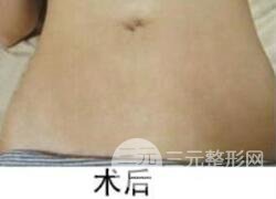 如何去除妊娠紋？做了果酸換膚去妊娠紋果不錯(cuò)，真人案例圖片分享