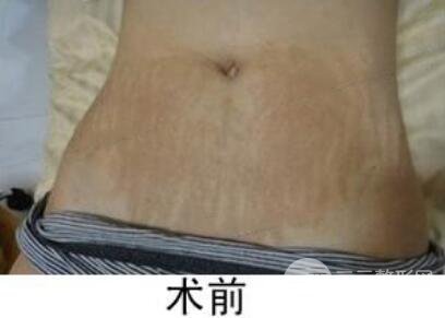 如何去除妊娠紋?做了果酸換膚去妊娠紋果不錯(cuò),真人案例圖片分享