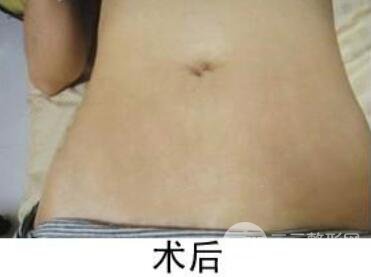 如何去除妊娠紋?做了果酸換膚去妊娠紋果不錯(cuò),真人案例圖片分享