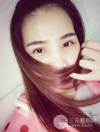 漢中韓美切開雙眼皮開眼角恢復對比照片