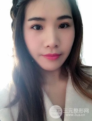 漢中韓美切開雙眼皮開眼角恢復對比照片