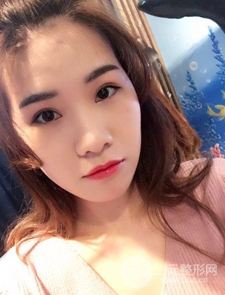 漢中韓美切開雙眼皮開眼角恢復對比照片