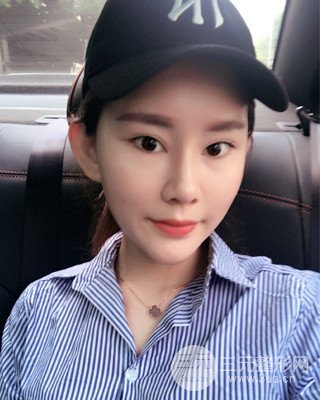 南昌永康自體脂肪面部填充兩個(gè)半月果圖