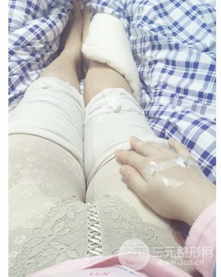 大腿吸脂前后對(duì)比照片，南昌永康王忠干真實(shí)案例分享