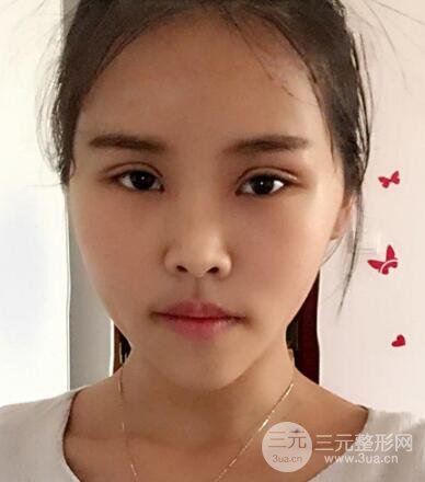 開內(nèi)眼角割雙眼皮案例介紹和恢復(fù)過程圖