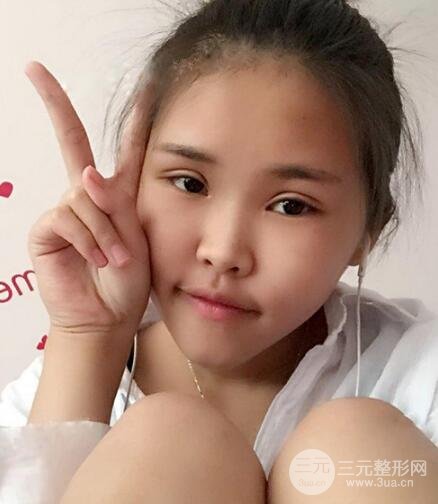 開內(nèi)眼角割雙眼皮案例介紹和恢復(fù)過程圖