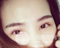 切開雙眼皮恢復過程對比圖和真人案例 切開雙眼皮價格4600元