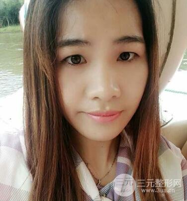 切開雙眼皮恢復(fù)過程對比圖和真人案例 切開雙眼皮價格4600元