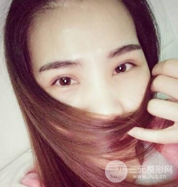 切開雙眼皮恢復(fù)過程對比圖和真人案例 切開雙眼皮價格4600元