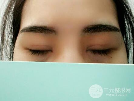 切開雙眼皮恢復(fù)過程對比圖和真人案例 切開雙眼皮價格4600元