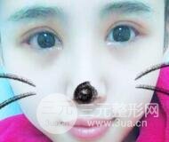 割雙眼皮六個月恢復過程圖片和真實案例