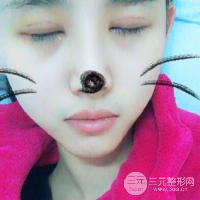 割雙眼皮六個(gè)月恢復(fù)過(guò)程圖片和真實(shí)案例