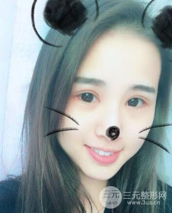 割雙眼皮六個(gè)月恢復(fù)過(guò)程圖片和真實(shí)案例