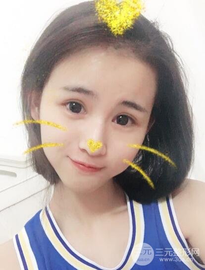 割雙眼皮六個(gè)月恢復(fù)過(guò)程圖片和真實(shí)案例