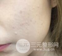 水光補水嫩膚果圖前后對比和恢復(fù)過程真實案例分享