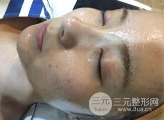 水光補(bǔ)水嫩膚果圖前后對比和恢復(fù)過程真實(shí)案例分享