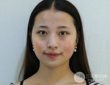 痘坑痘疤要怎么修復(fù)？果酸換膚后臉果圖和真實(shí)案例分享
