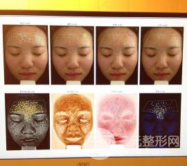 痘坑痘疤要怎么修復(fù)？果酸換膚后臉果圖和真實(shí)案例分享